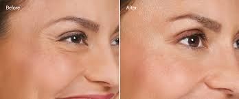 Where to Get Botox near Manhattan Beach With Natural Results
