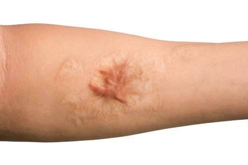 Valuing a California Dog Bite Case When the Scarring Is Permanent